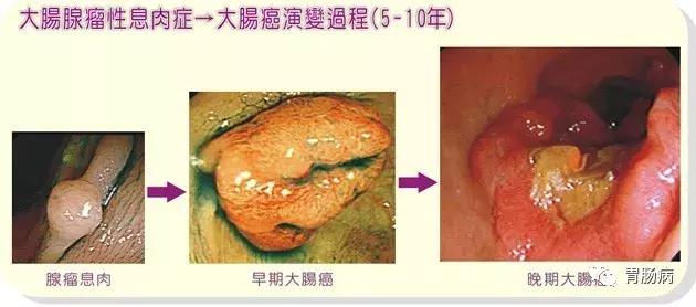 大肠息肉到大肠癌早期要多长时间,大肠息肉癌早期10大征兆