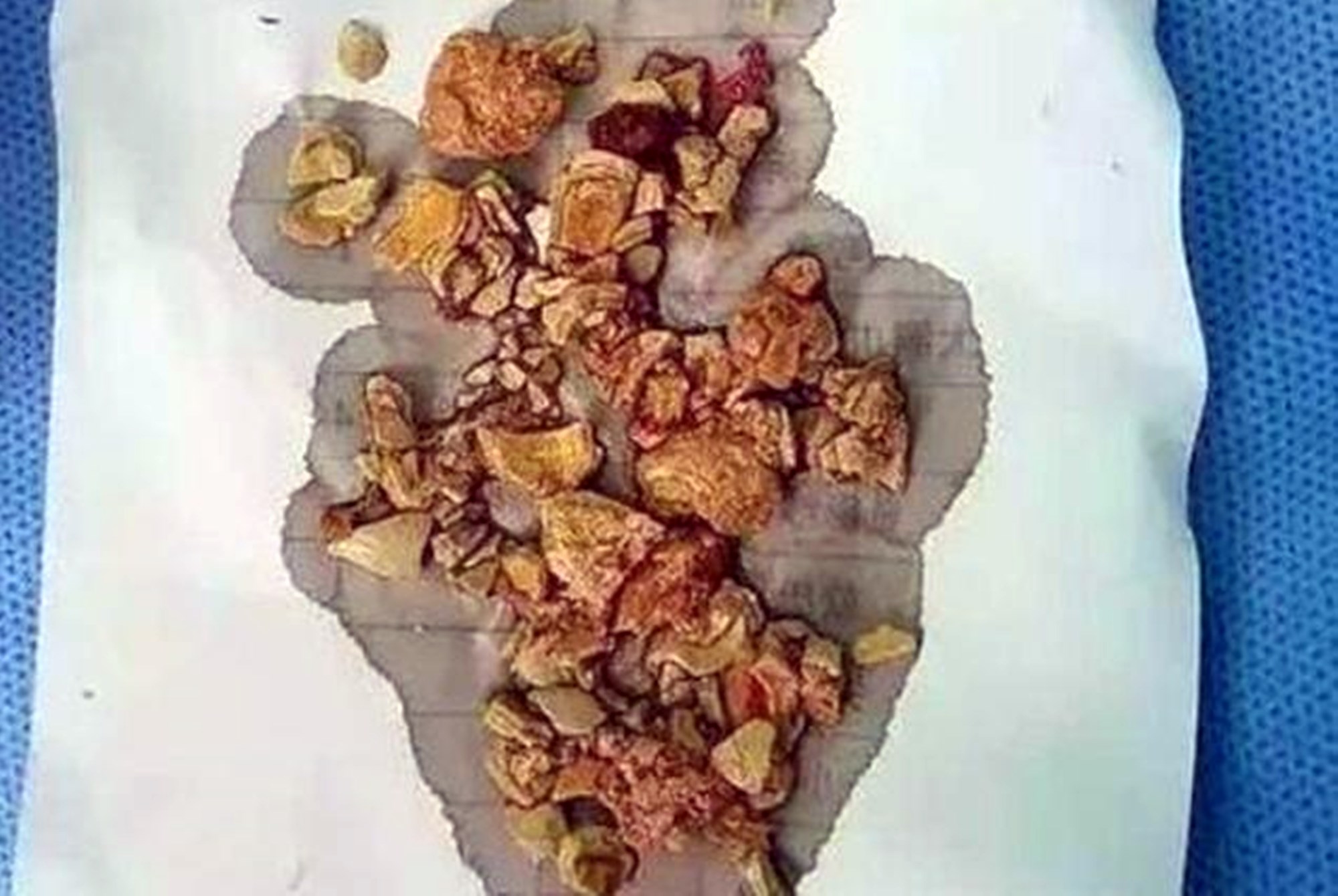 宝宝积食不宜吃的三种辅食,婴儿积食是辅食造成的吗