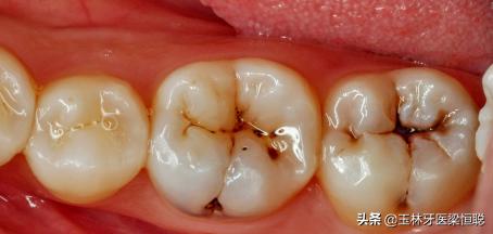 浅蛀牙补牙齿一般多少钱,牙齿蛀牙补一颗要多少钱