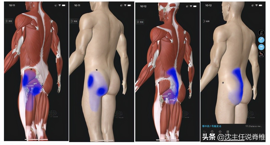 腰突引起的臀部麻腿疼哪个严重,怎样解决腰突带来的臀腿胀痛