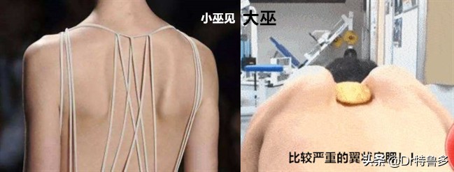 蝴蝶骨不是一种病吗,蝴蝶骨是颈椎病吗