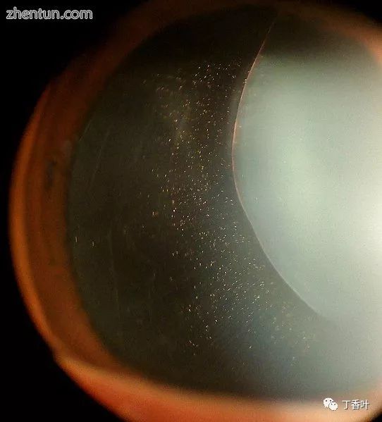 马凡综合征特殊面容,马凡综合征完整