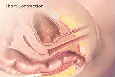 产后下垂要做盆底肌修复吗,产后真的要做盆底肌修复吗