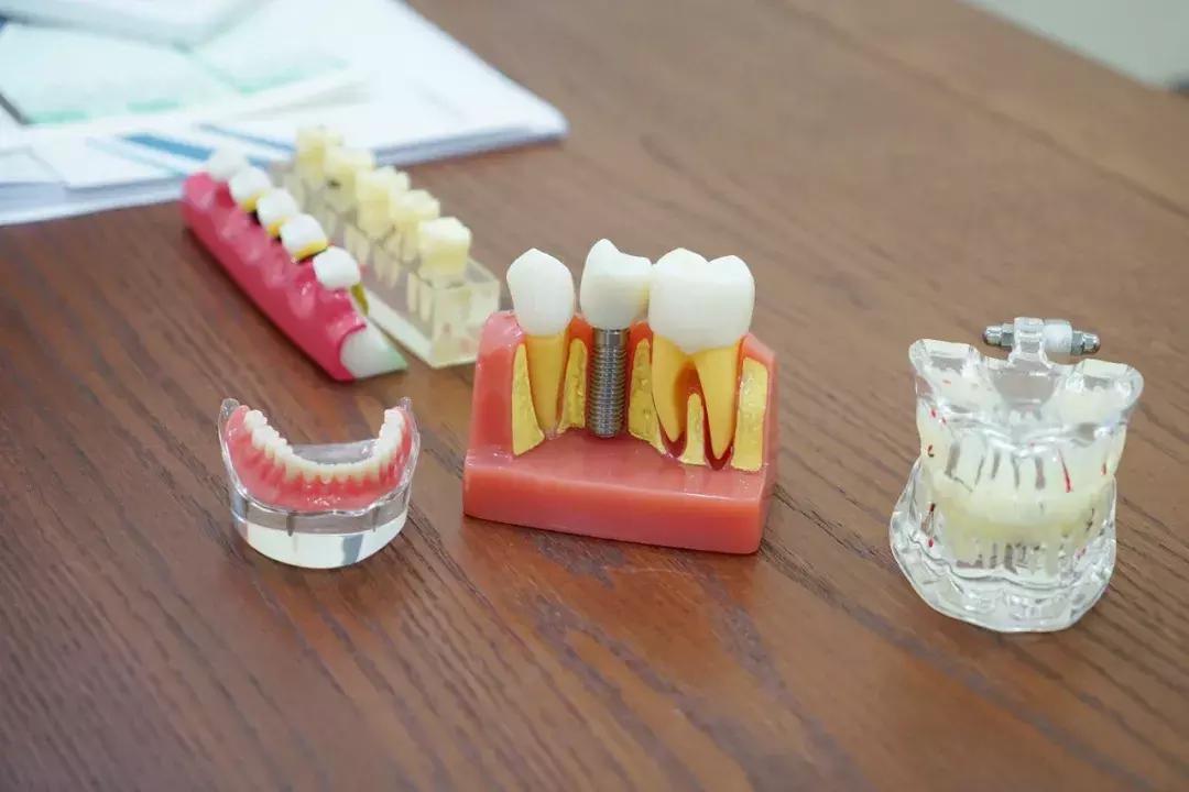 雅贝嘉种植牙特惠,种植牙超低特惠倒计时1天