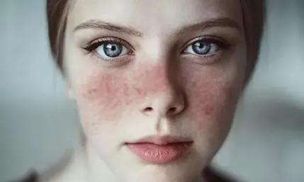 系统性红斑狼疮治疗新突破,战狼红斑狼疮