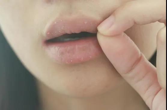 唇部特别干燥是什么原因,唇部发黑发乌起皮干燥怎么办