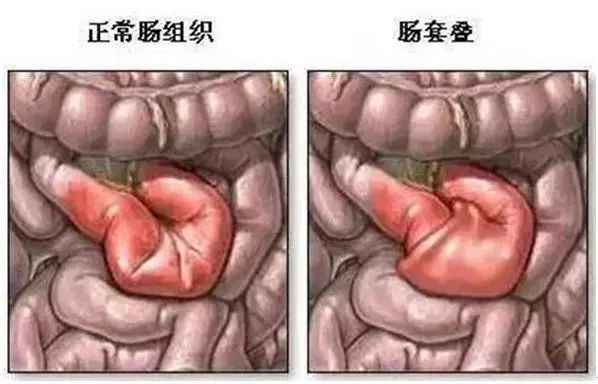 肠套叠最明显的症状有几点，多发于这些婴幼儿，黄金治疗期12小时