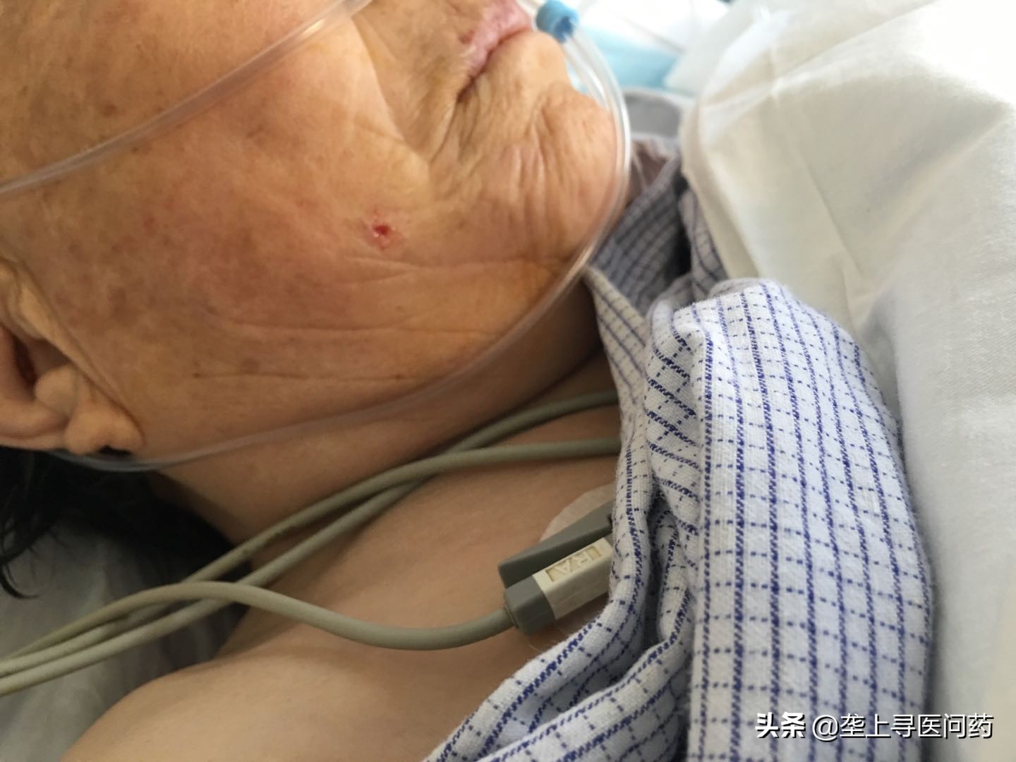 武汉市同济医院神经内科,武汉同济三叉神经手术