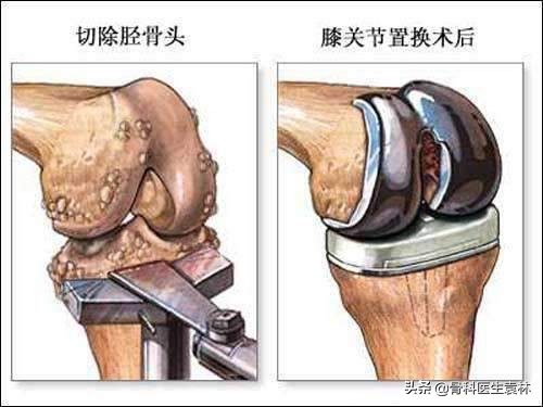 长了骨刺适合吃钙片么,长了骨刺到底该不该运动
