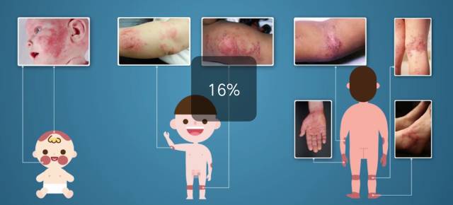 宝宝疹子怎么解决,宝宝疹子是怎么引起的