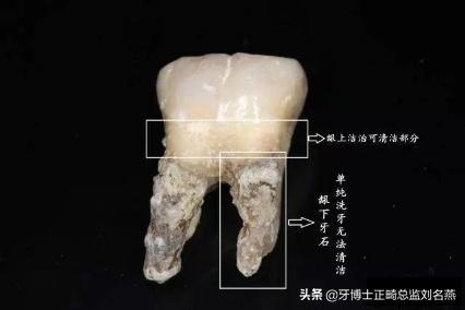 洗个牙1000块,洗个牙被人家骗几千块