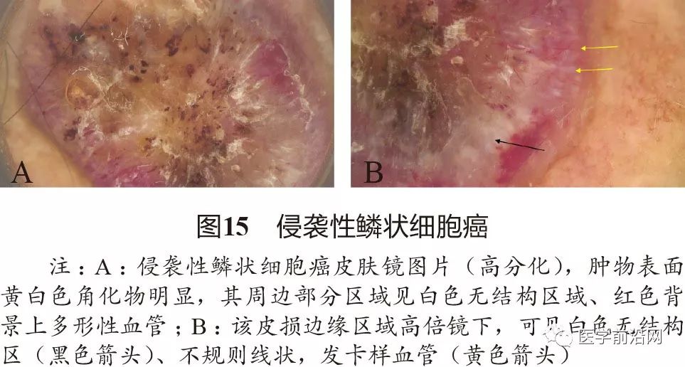 面部常见皮肤病皮肤镜诊断专家共识全文发布