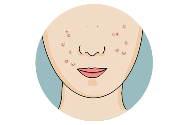 月经期间长痘可以治愈吗,经期长痘应该使用什么消痘