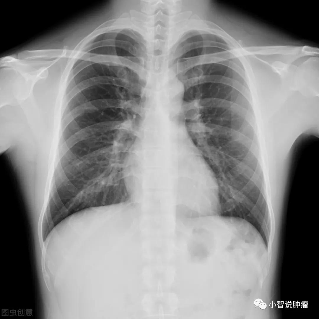 年年体检，忽然被告知肺癌晚期！早期筛查真的有用吗？