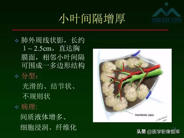 肺弥漫性网状影,两肺小叶间隔增厚可见网状模糊影