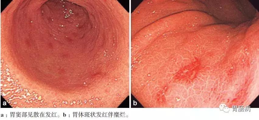 非浅表性萎缩胃炎会癌变吗,浅表性非萎缩胃炎用什么药