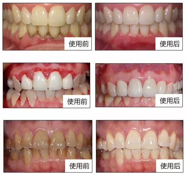 2岁半宝宝口臭幽门螺旋杆菌,4岁的宝宝有口臭是积食吗