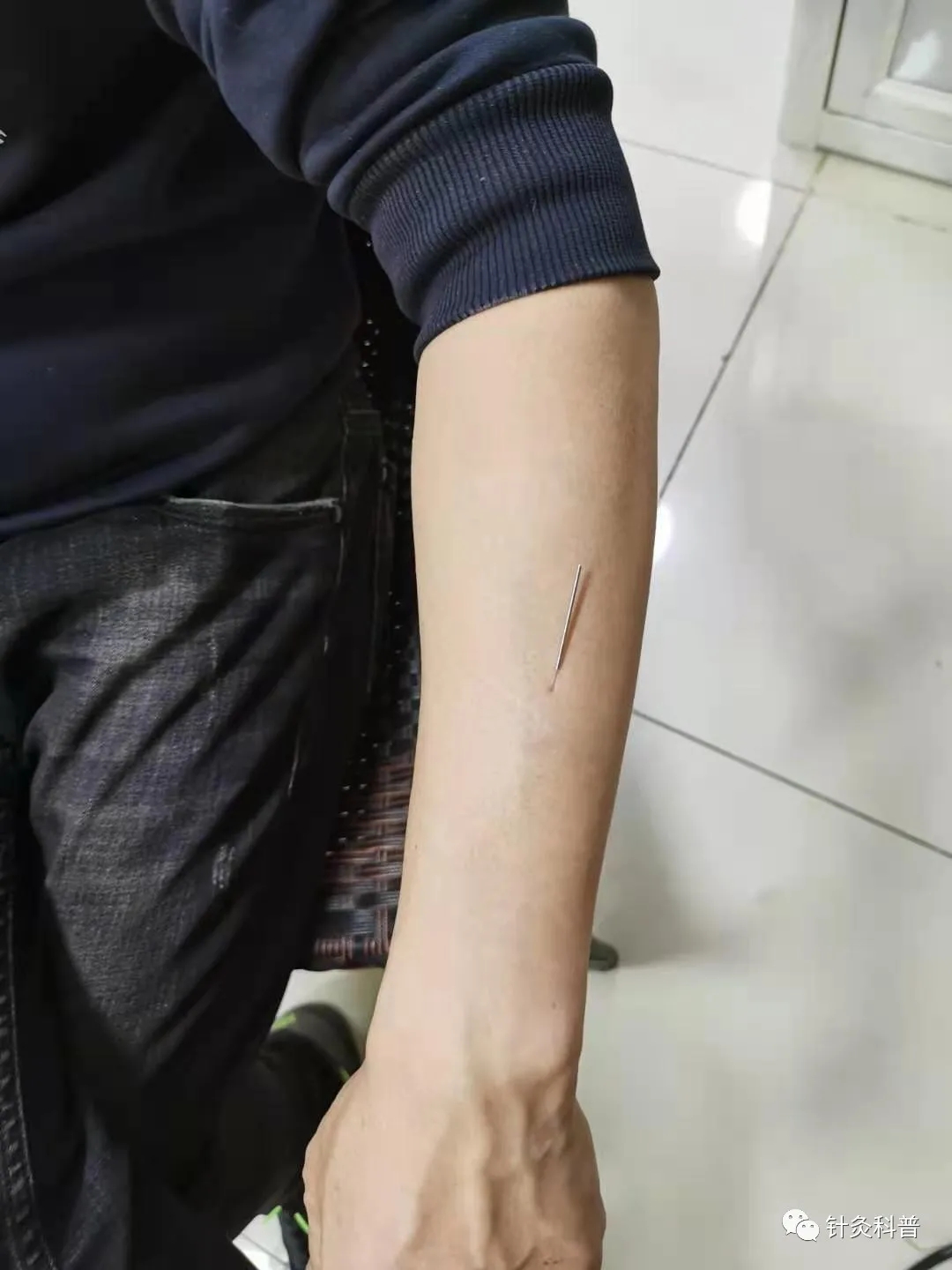 肩背痛一针针灸法,针灸治疗颈肩腰腿痛