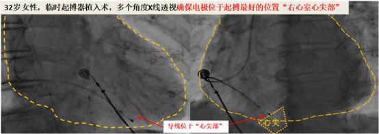 急诊手术后32岁的新妈妈对我说“医生，一点不痛，很享受”