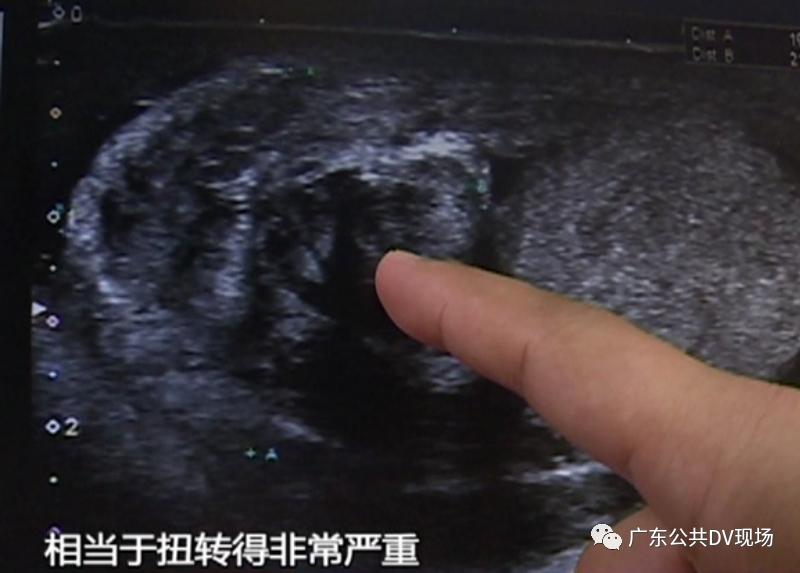 “蛋蛋”的忧伤！男孩突然“蛋疼”不止，隔天送医被切除，医生提醒