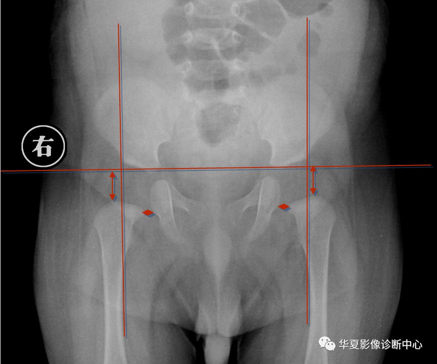 先天性髋关节脱位饮食,先天性髋关节脱位属不属于残疾人