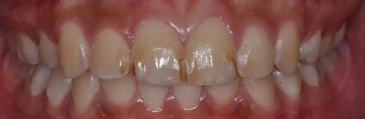 美白牙膏去牙黄真实有效测评,美白牙膏真实测评护牙效果