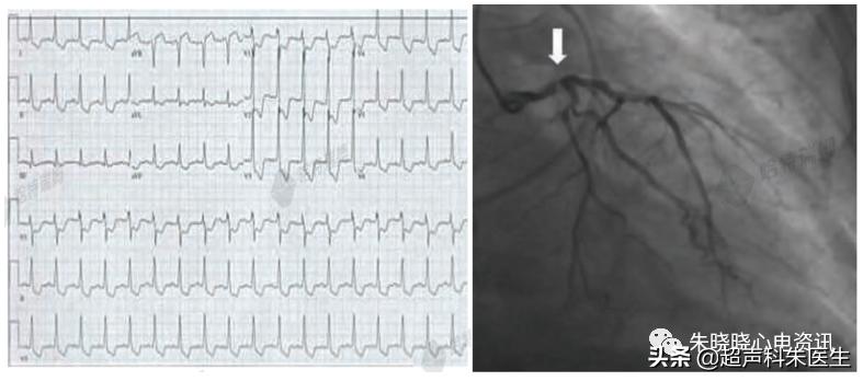 t波倒置诊断,t波倒置如何区分严重程度