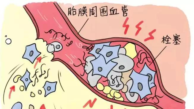 羊水栓塞的早期症状,羊水栓塞是怎么引起的有危险吗