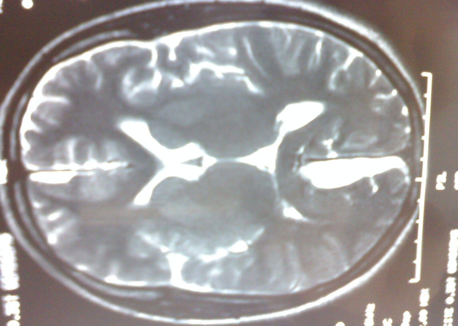 最常见的先天性脊柱侧凸的病因,先天性脊柱凸起怎么治疗