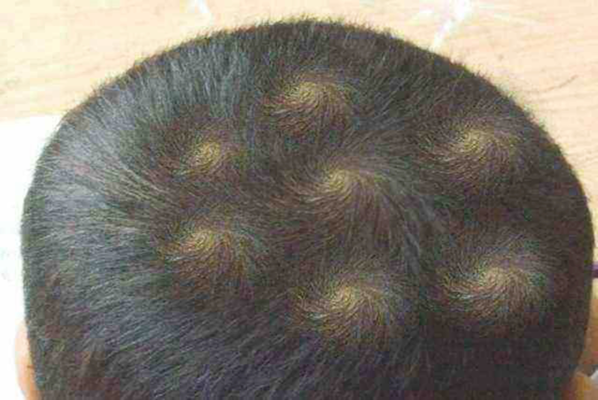 孩子头旋是逆时针智商低吗,宝宝的头旋偏右