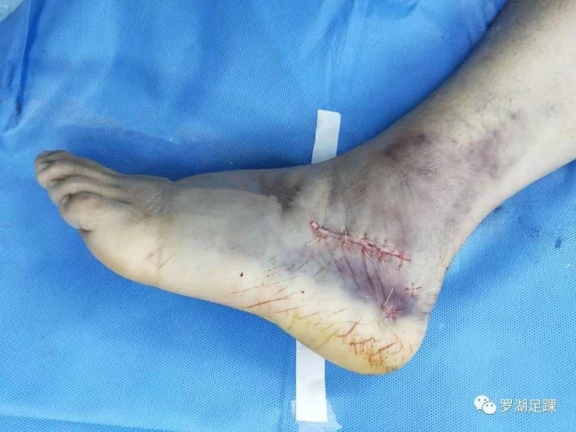 左股骨粗隆间粉碎性骨折微创手术,跟骨粉碎性骨折微创手术最快多久