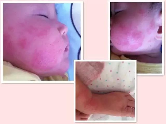 新生儿热疹和湿疹的预防与护理,又到了过敏高发期