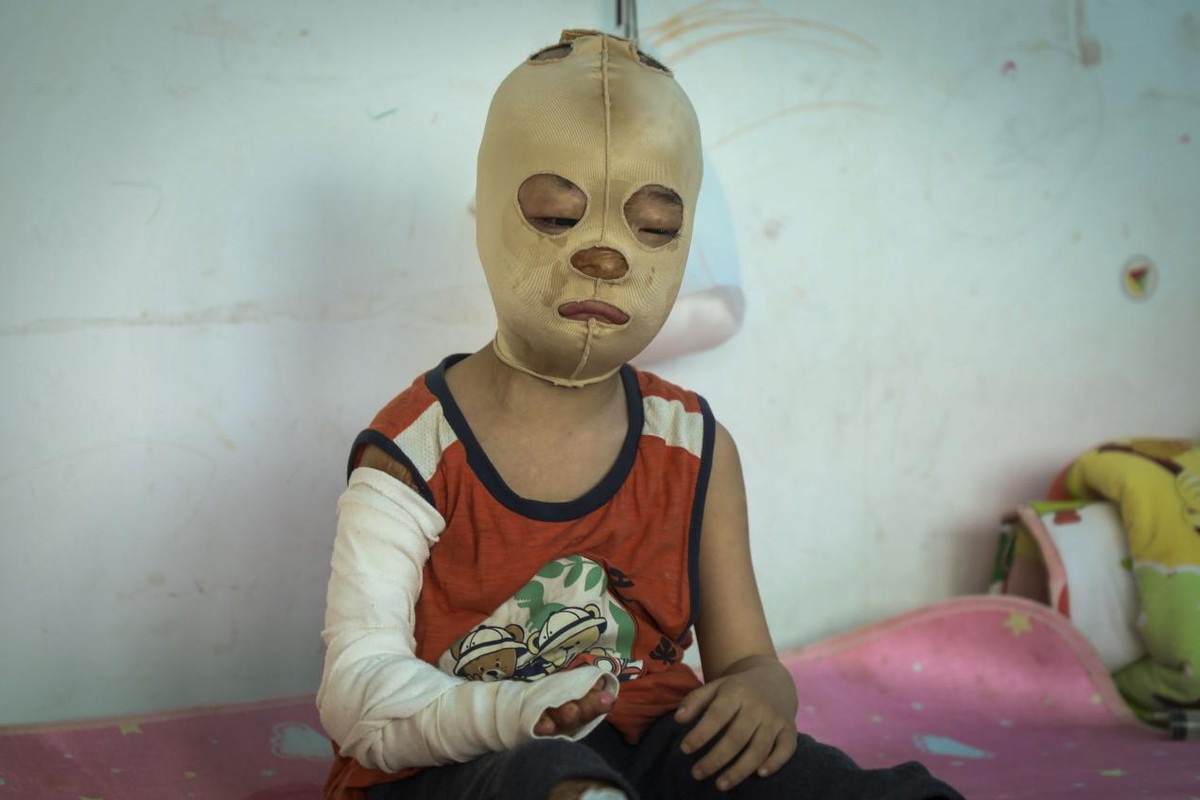 孩子被开水烫伤母亲却只心疼杯子,小孩掉进开水盆80%烫伤