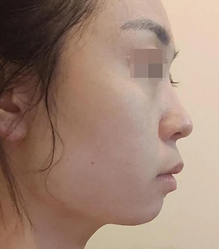 鼻部不立体,鼻部垫高