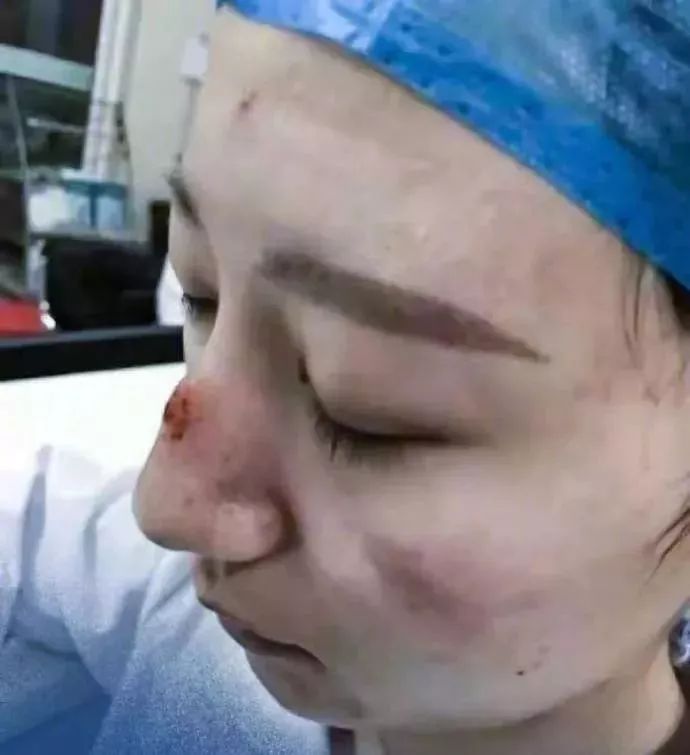 长时间戴口罩皮肤发红怎么办,戴口罩脸部有压痕怎么办