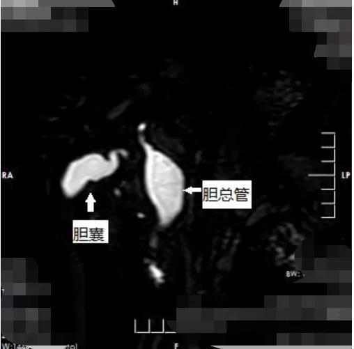 十年前得肝内胆管结石,腹部b超能查出胆总管囊肿