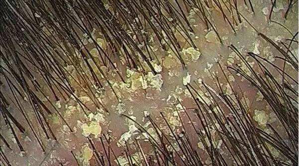 梦禾科普｜如何对付烦人的头皮屑