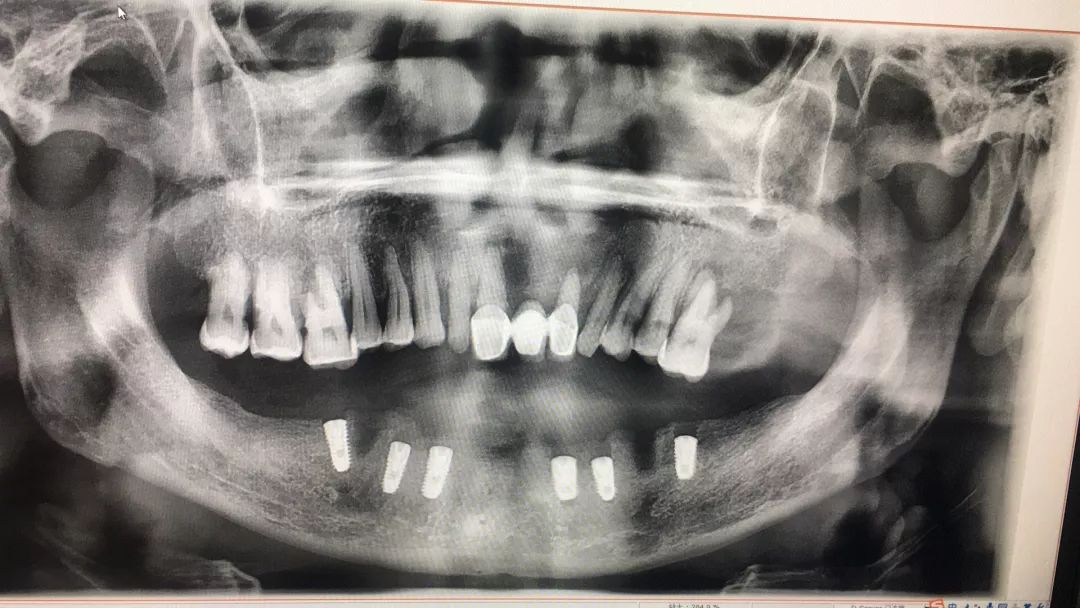 种牙去正规医院好还是口腔医院好,西安哪家医院种牙经济实惠便宜