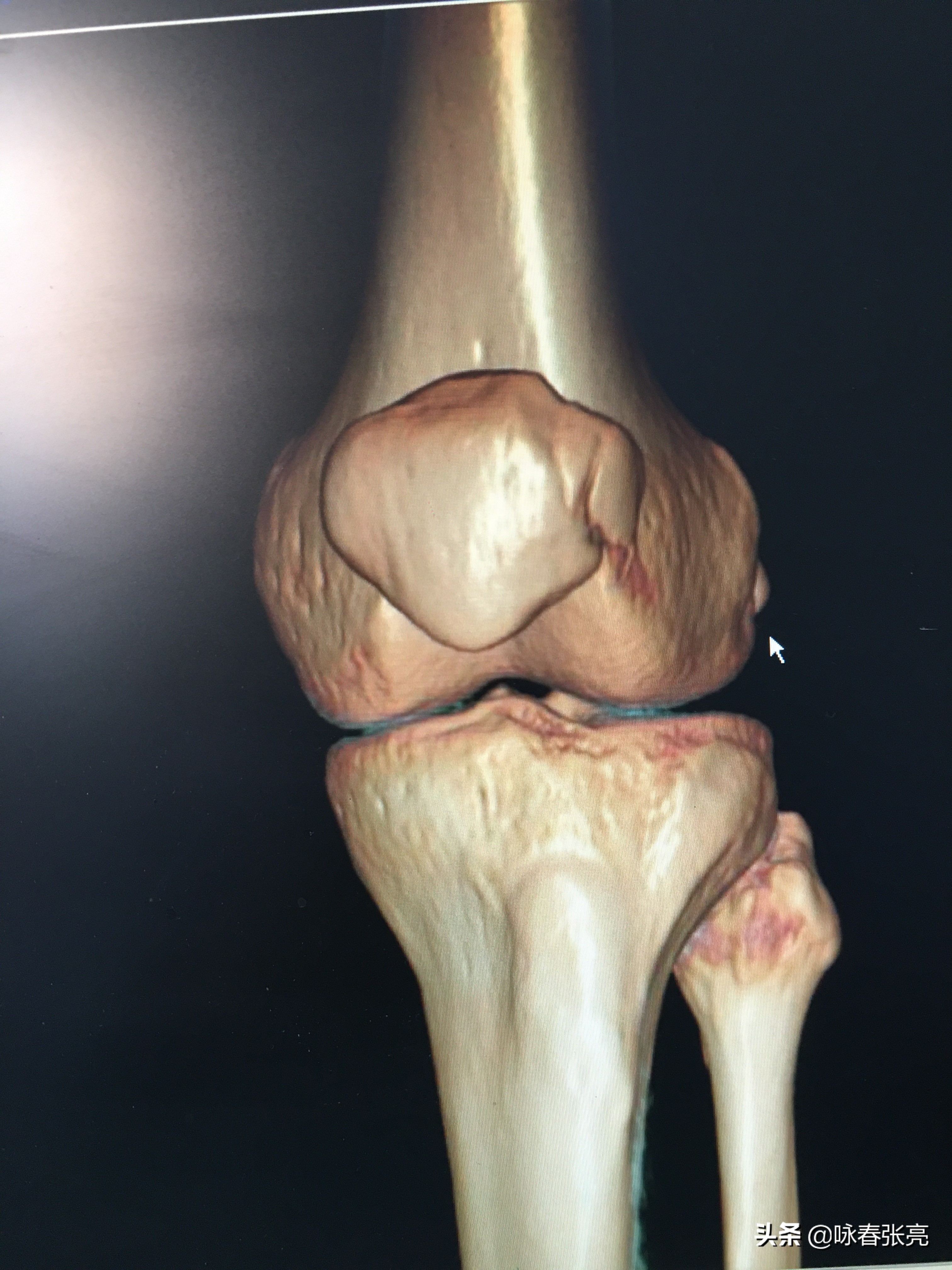 马步蹲怎样不伤膝,马步脚尖朝里还是朝外不伤膝