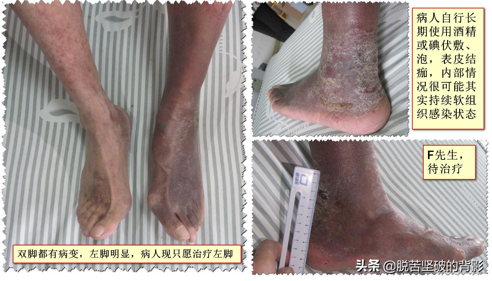 小小外伤4年8次住院，三甲医生举案说法：健康无小伤，手术须慎行