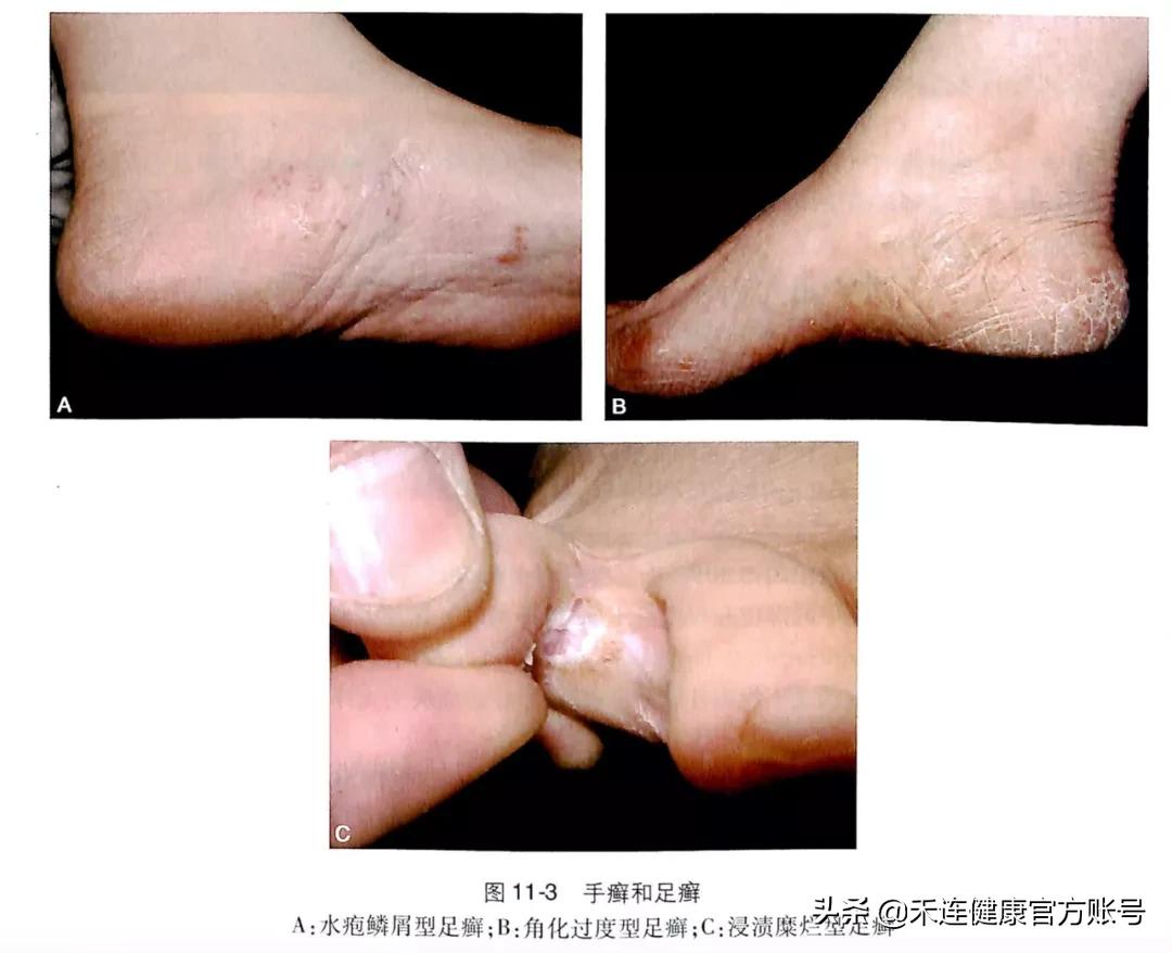 脚气脚痒小妙招,脚气脚痒教你一招彻底解决土办法