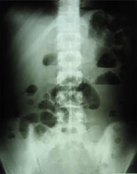 系统性红斑狼疮肠道病变,系统性红斑狼疮消化系统症状