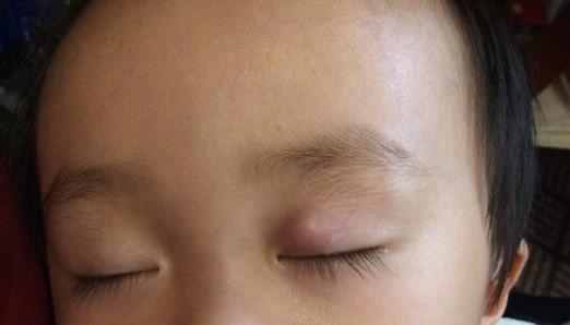 眼皮出现黄斑要警惕,眼皮上有异物怎么处理