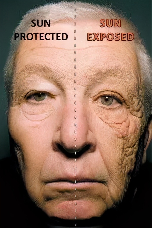 脸上褶子多自己能恢复吗,脸上的褶子越来越多