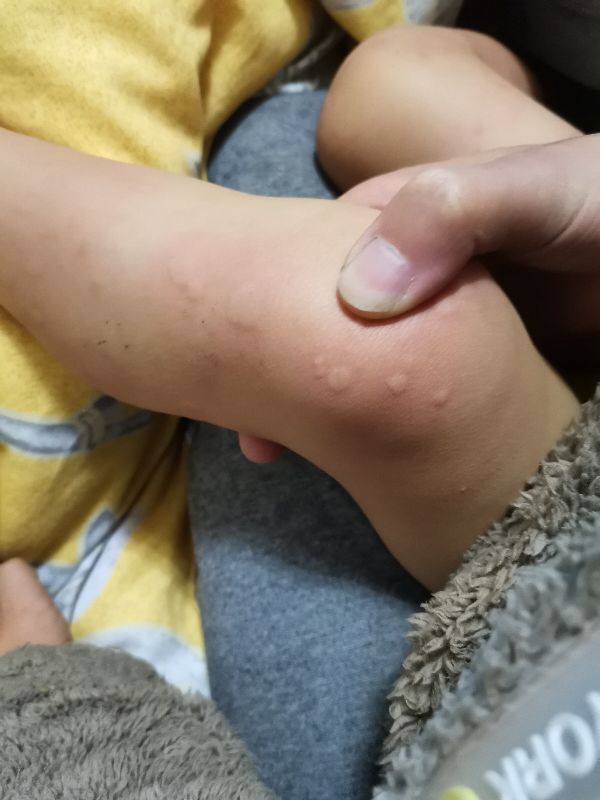 宝宝身上起疙瘩像蚊子咬一样还痒,宝宝身上长疙瘩像蚊虫叮咬怎么办