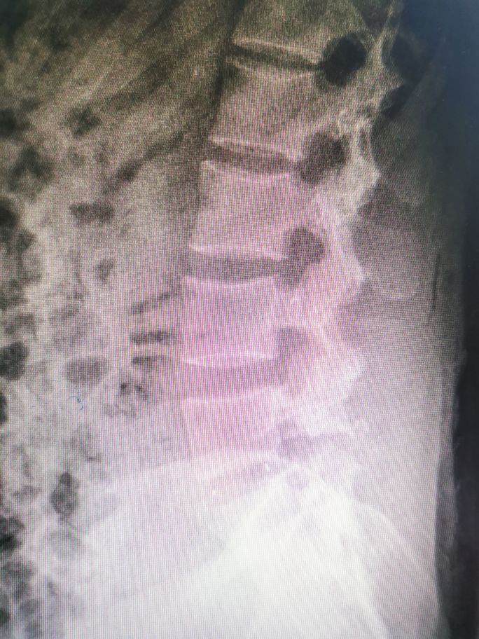 腰椎滑脱的治疗方法,腰椎滑脱手术医保多少钱