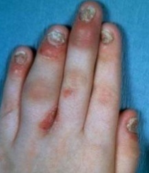 银屑病关节炎炎症怎么消除,银屑病关节炎扶他林乳膏