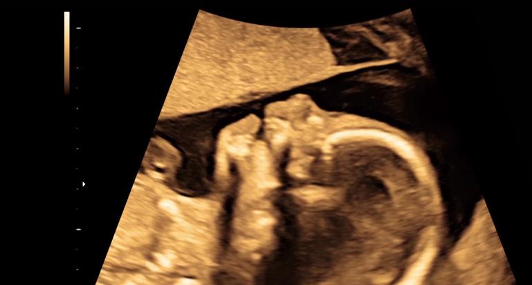 腹中胎儿长出肿瘤，孕妇忍着剧痛，给胎儿打麻药做手术