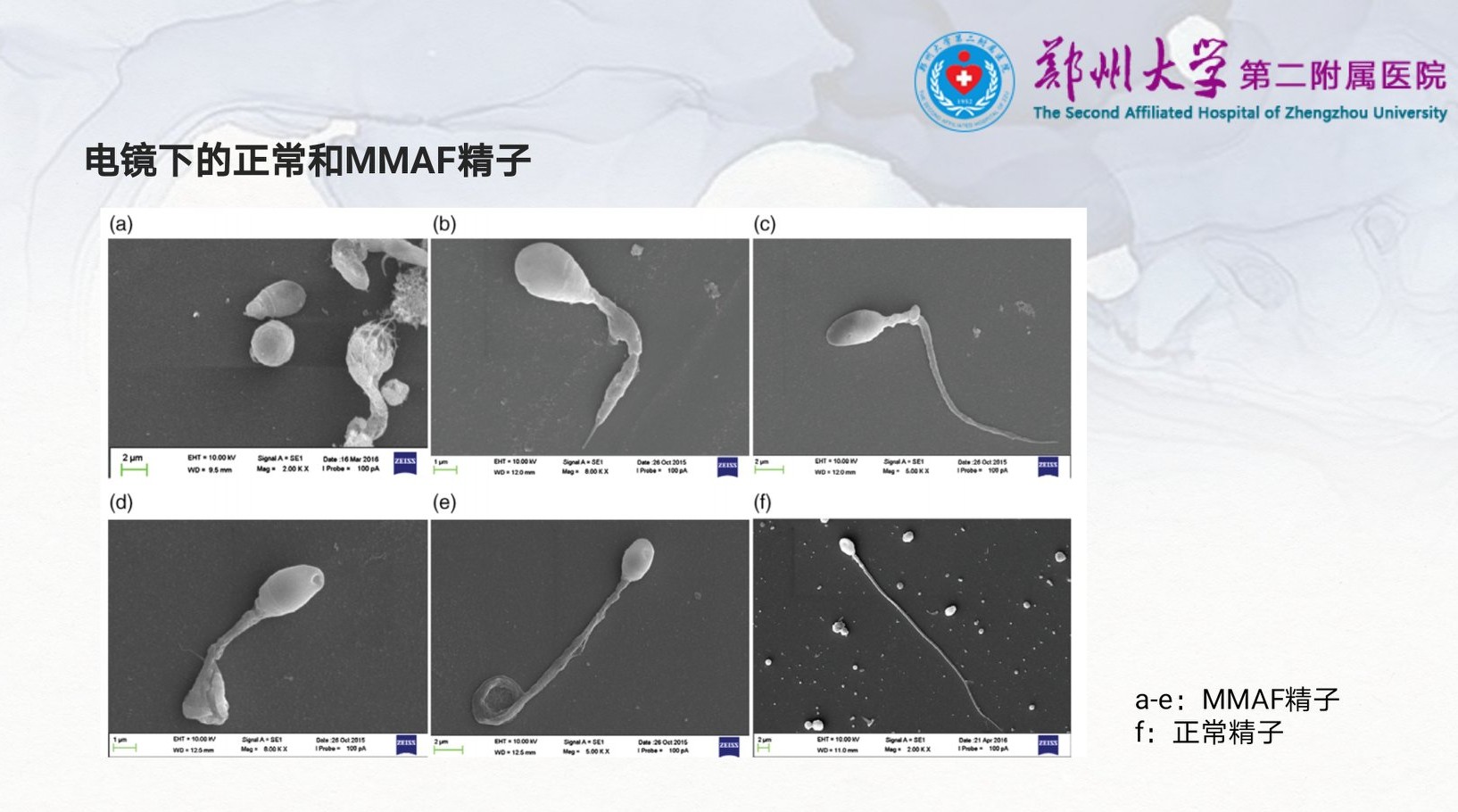 严重弱精症和完全无活动精子的原因是啥？