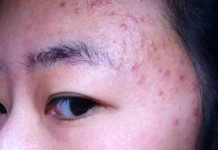 患了毛囊炎应该注意什么,患上毛囊炎要注意哪些呢